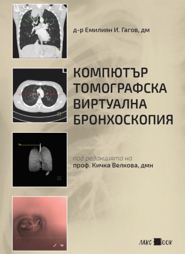 Компютър-томографска виртуална бронхоспокопия